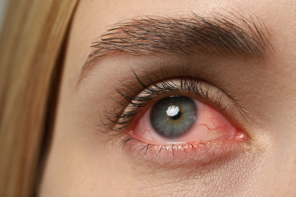 Dealing with Red Eyes in Contact Lens Wear: What You Should Know